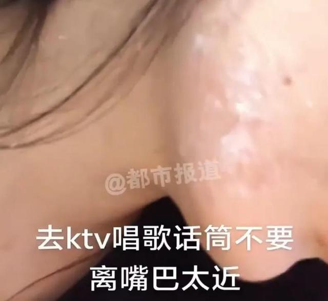 “终身携带，无药可治……”女子唱K离话筒太近感染病毒