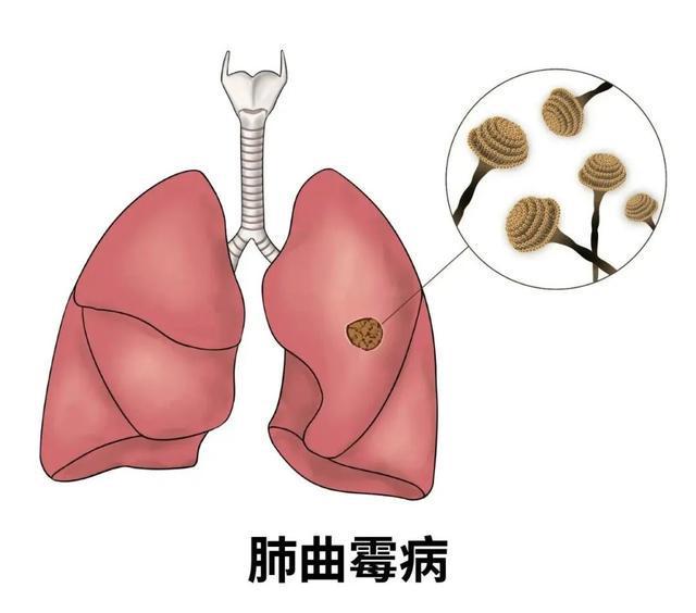 女子高烧40℃、肺部“发霉” ！只因在家整理了衣柜