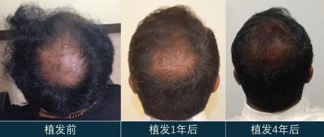 那些植发的人，后来头发都变浓密了吗？