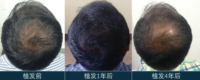 那些植发的人，后来头发都变浓密了吗？