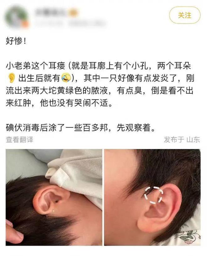 可怕！耳朵上的这个小洞，可能是个不定时炸弹……