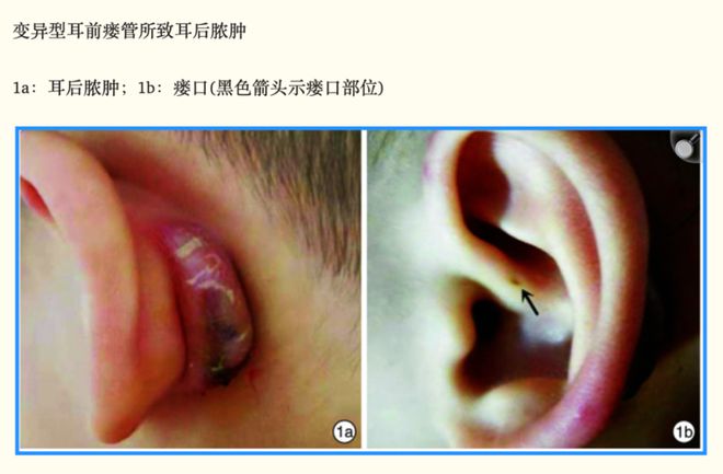 可怕！耳朵上的这个小洞，可能是个不定时炸弹……